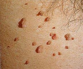 cilvēka papilomas vīruss uz ādas