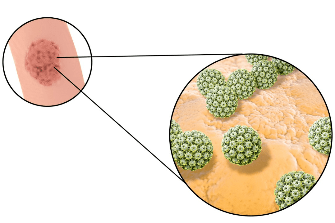 infekcijas avots ar plakanšūnu papilomu